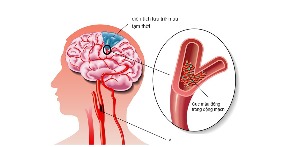 Do bị thiếu máu lên não